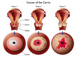 Carcinoma cervicale
