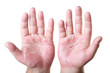 two male palms with eczema isolated on white background