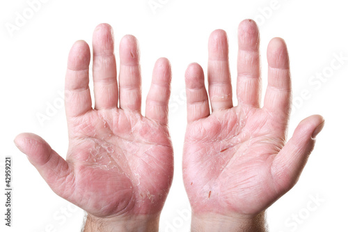 Photo: two male palms with eczema isolated on white background two male palms with eczema isolated on white background