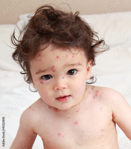 Photo: Baby suffering with chicken pox Baby suffering with chicken pox