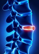 Ruptured disc in x-ray