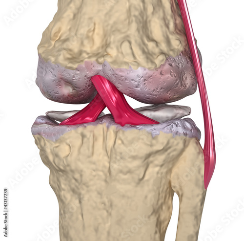 Illustration: Osteoarthritis : Knee joint with ligaments and cartilages Osteoarthritis : Knee joint with ligaments and cartilages