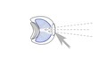 Eye surgery inlay
