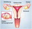 Illustration: Eileiterschwangerschaft Eileiterschwangerschaft