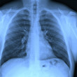 X-ray chest