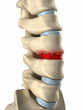 Disc degenarated by osteophyte formation