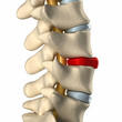 Ruptured disc in lateral view