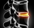 Degenerated disk in x-ray view - close up