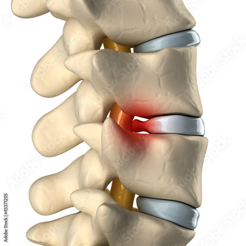 Illustration: Disc herniated Disc herniated