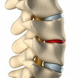 Thinning disc