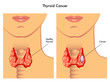 carcinoma tiroideo