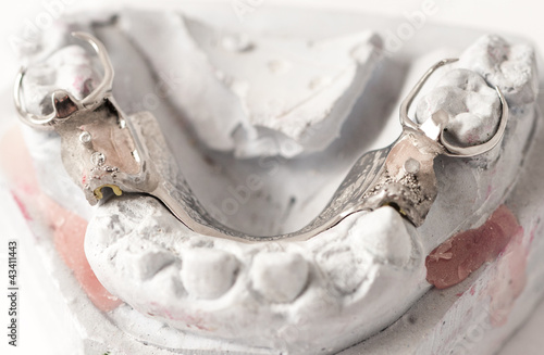 Foto: Metal Ceramic Bridge Metal Ceramic Bridge