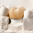 Photo: Zirconia Crown, Molar Zirconia Crown, Molar
