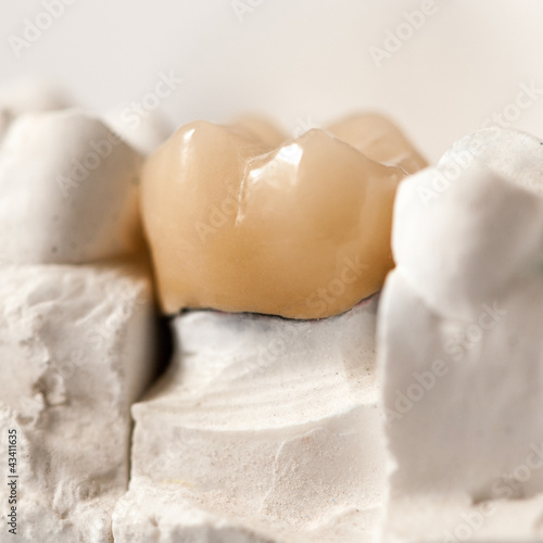 Photo: Zirconia Crown, Molar Zirconia Crown, Molar