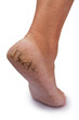 chapped heel