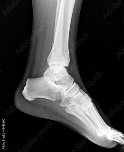 Photo: Left foot MRI with toes - X-ray Left foot MRI with toes - X-ray