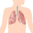 Lung cancer, eps10