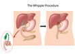 The Whipple Procedure, eps10
