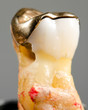 pulled tooth, big hole and bad fitting gold inlay