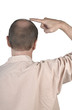 Foto: Human hair loss - adult man hand pointing his bald head Human hair loss - adult man hand pointing his bald head
