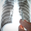 showing x-ray picture lumbar vertebra.