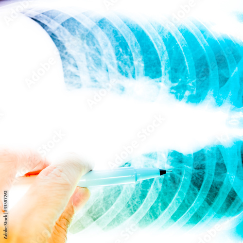 Photo: showing x-ray picture lumbar vertebra. showing x-ray picture lumbar vertebra.
