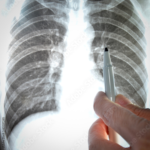 Photo: showing x-ray picture lumbar vertebra. showing x-ray picture lumbar vertebra.