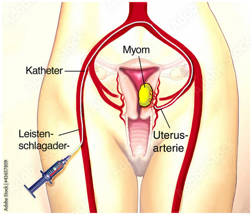 Illustration: Myom aushungern Myom aushungern
