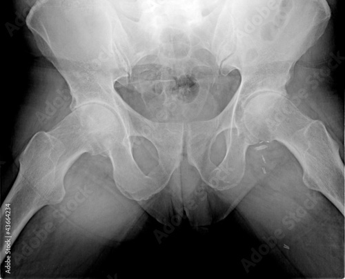 Photo: Regular hip of a young man on x-ray, isolated on black backgroun Regular hip of a young man on x-ray, isolated on black backgroun