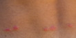 flea bites