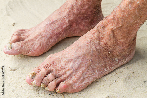 Photo: Patients legs of an old woman Patients legs of an old woman