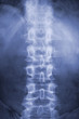 Spine and pelvis of a human body on x-ray
