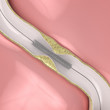 Coronary Angioplasty procedure - plague blocking blood flow