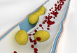 Blood Clot Formation Around Plaque