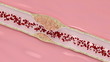 Coronary atherosclerosis desease