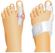 Hallux valgus, popularly known as Bunion.