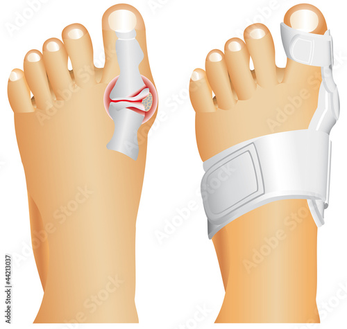Vector: Hallux valgus, popularly known as Bunion. Hallux valgus, popularly known as Bunion.