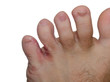 Foot fungus