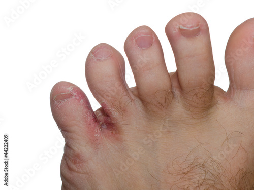 Photo: Foot fungus Foot fungus