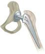 Replacement hip joint, artificial joint