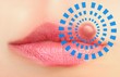 Close up of lips affected by herpes (cold sore)