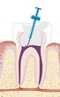 Zahnwurzelbehandlung, Endodontie 4