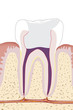 Zahnwurzelbehandlung, Endodontie 5