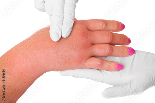 Photo: Swollen hand Swollen hand