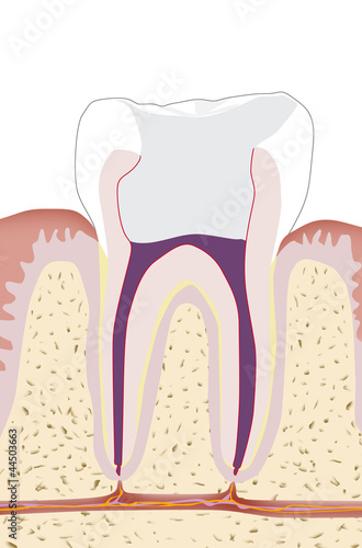 Illustration: Zahnwurzelbehandlung, Endodontie 5 Zahnwurzelbehandlung, Endodontie 5