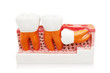 Photo: Unperfect growth of dental Unperfect growth of dental