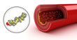Illustration: Cholesterol plaque in artery and cholesterol model Cholesterol plaque in artery and cholesterol model