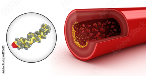 Illustration: Cholesterol plaque in artery and cholesterol model Cholesterol plaque in artery and cholesterol model