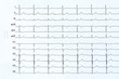 Herz Elektrokardiogramm formatfüllend (ohne Infarkt)
