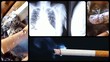 Video: danger of smoking series, two danger of smoking series, two
